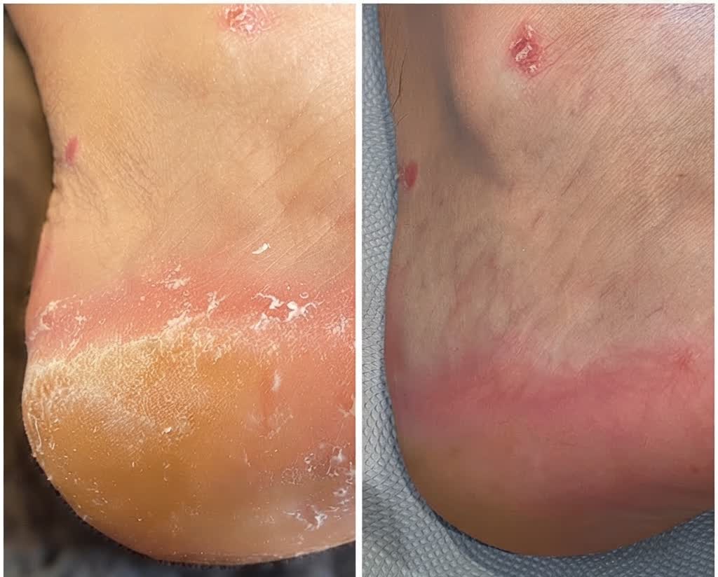 Efekty pedicure medycznego — stopa przed i po