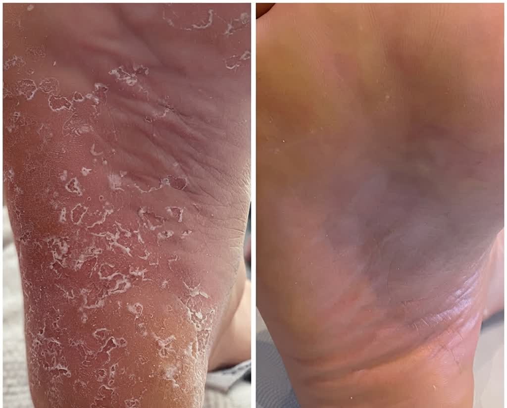 Efekty pedicure medycznego — pięta przed i po